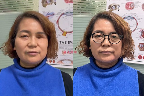 眼球萎缩眼窝修复（中青年适用）